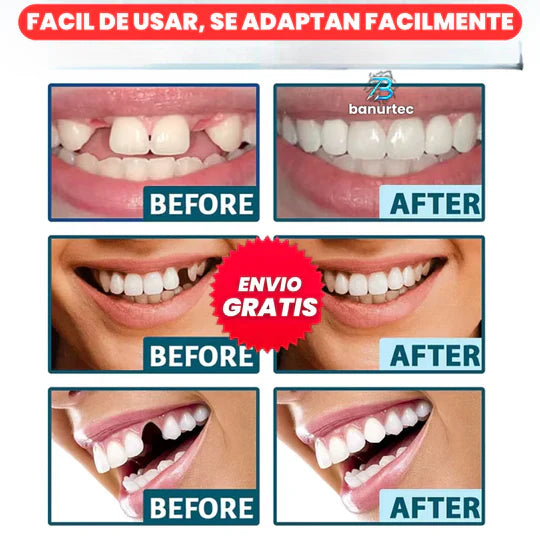 🚨OFERTA 2x1🚨: Carillas Dentales Snap On Smile🦷 | Luce una Sonrisa Soñada