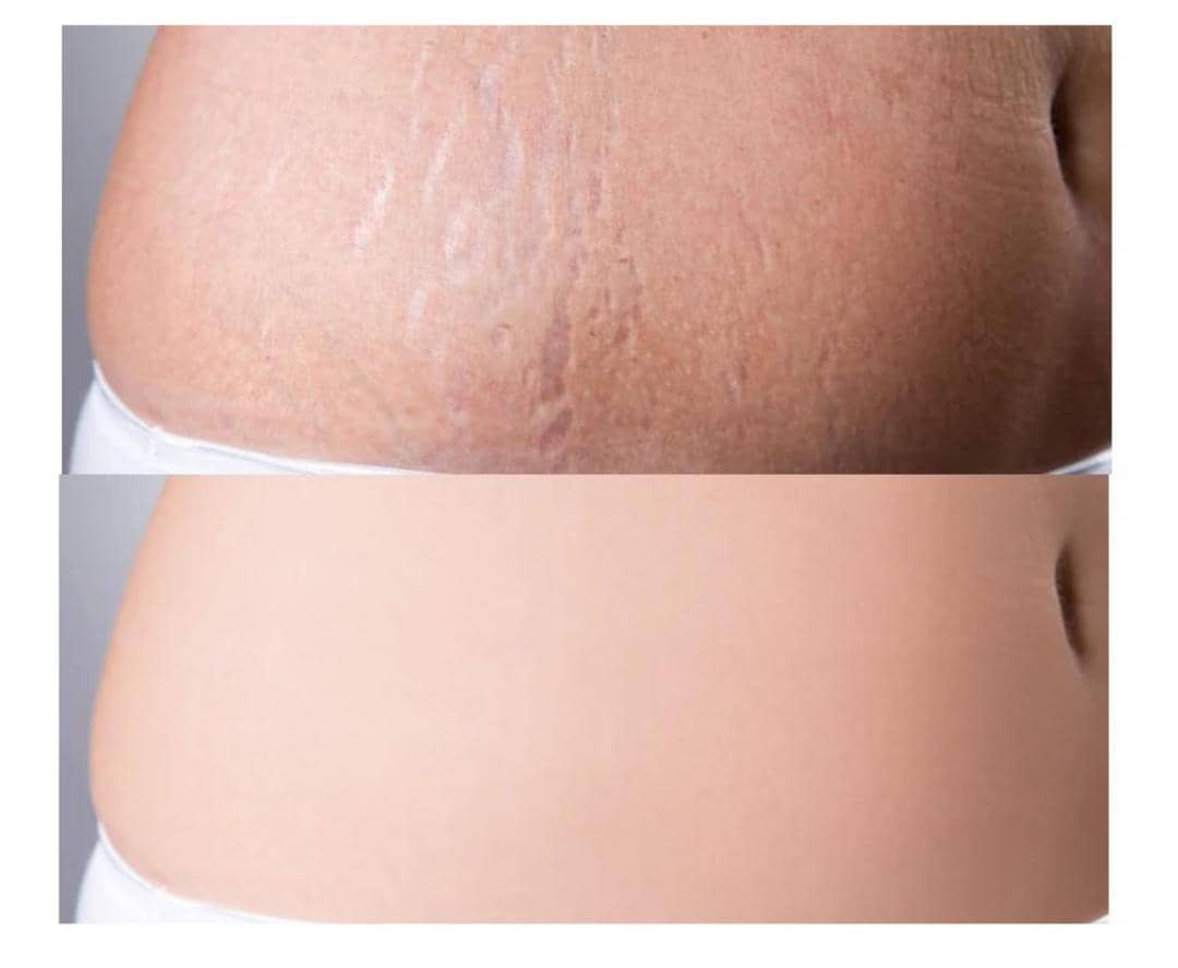 South Moon Stretch Marks Cream – Traitement intensif anti-vergetures